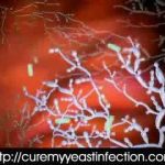 Things You Need To Know About Yeast Infection